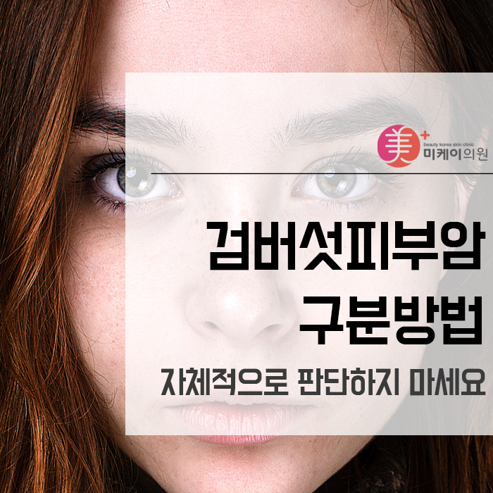 검버섯피부암구분방법 자체적으로 판단하지 마세요 관련 이미지 1