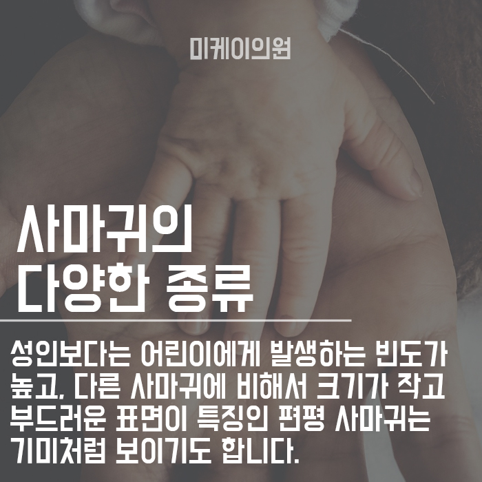 사마귀 생기는 이유 왜 자꾸 생겨날까? 관련 이미지 2