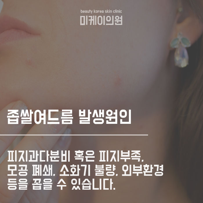 좁쌀여드름피부과 아직도 고민 중 이신가요 관련 이미지 2
