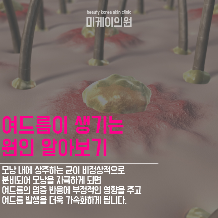 강남여드름관리 원인부터 바로잡자 관련 이미지 2
