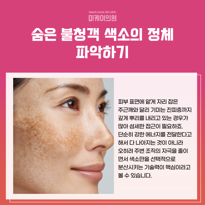 강남역 레이저토닝 기미 잡티 고민 관련 이미지 2