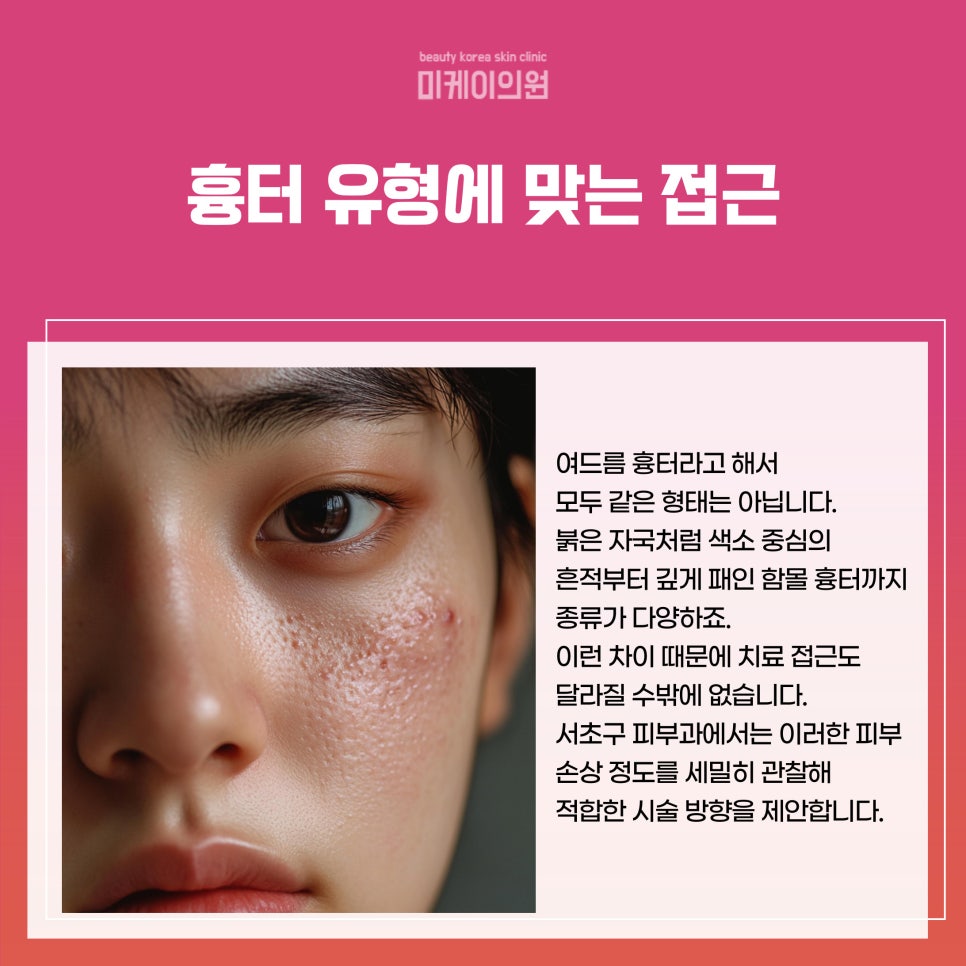 Acne Scar Treatment at a Dermatology Clinic in Seocho-gu image 2