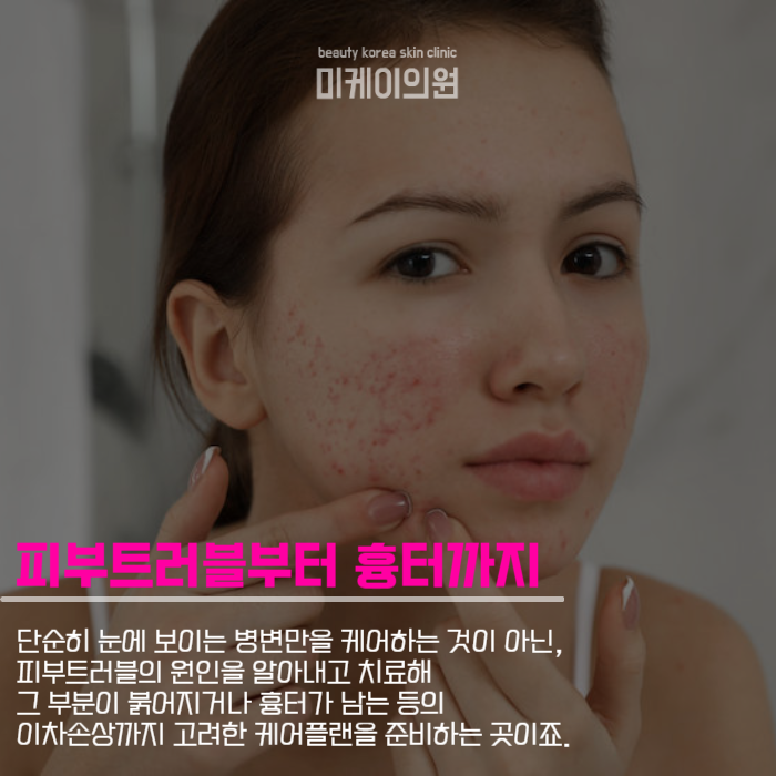 강남역여드름관리 병변부터 흉터까지 관련 이미지 3