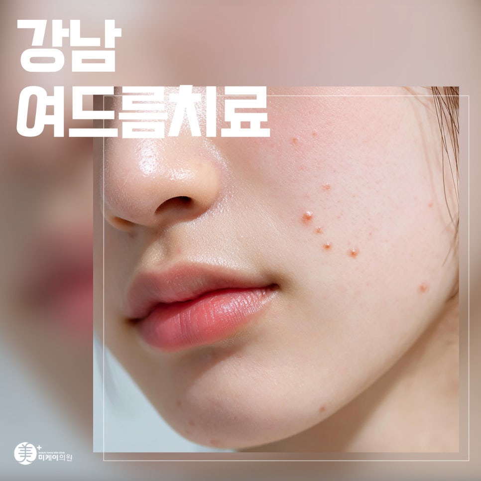Start Gangnam Acne Treatment the Right Way image 1