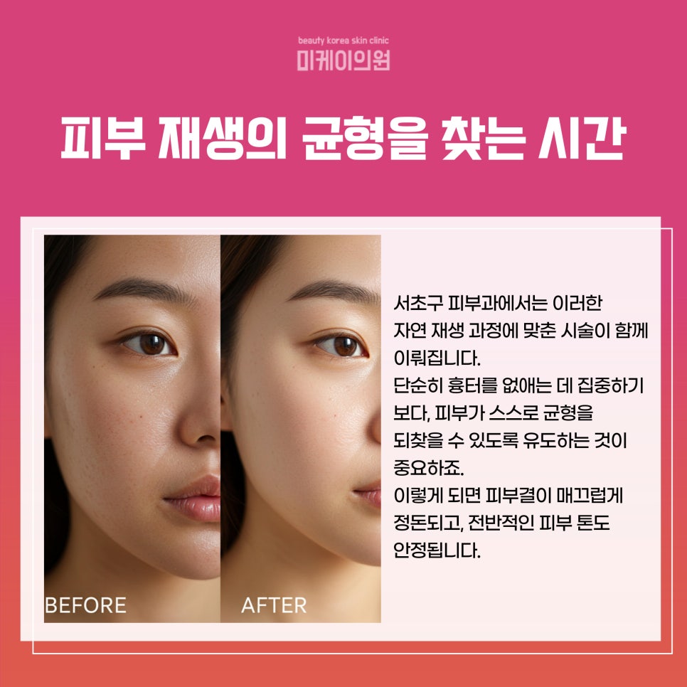 Acne Scar Treatment at a Dermatology Clinic in Seocho-gu image 3