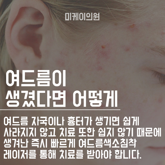 여드름색소침착레이저 깨끗하고 맑은 피부로 관련 이미지 2