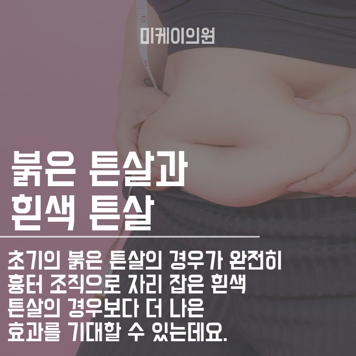 튼살관리방법 초기에 적극적으로 관련 이미지 4
