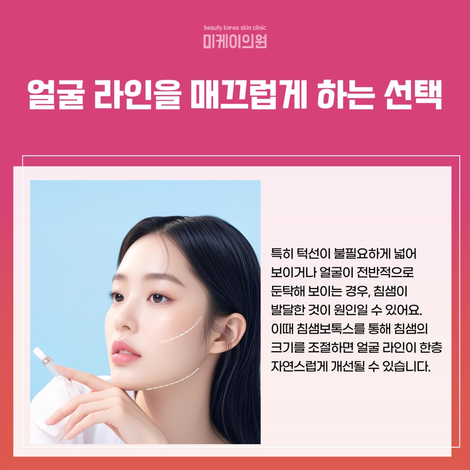 Gangnam Station Salivary Gland Botox, a Choice for Subtle Confidence image 2