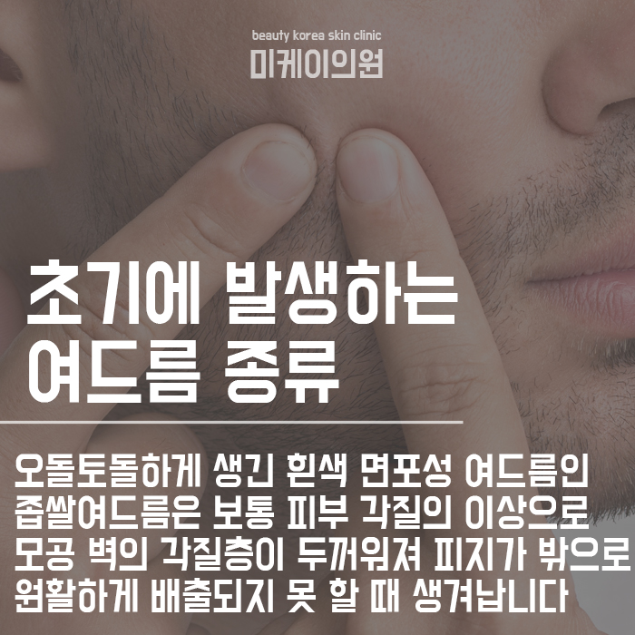 서초구피부관리 좁쌀여드름원인 및 관리법 초기부터 관련 이미지 3