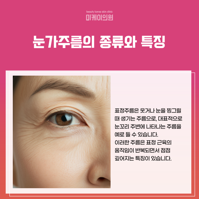 강남 눈가주름관리 아이슈링크와 주름보톡스로 해결 관련 이미지 2