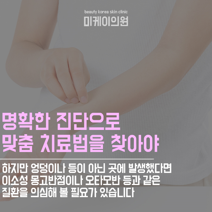 몽고반점제거방법 개인의 피부 타입을 고려해야 관련 이미지 2