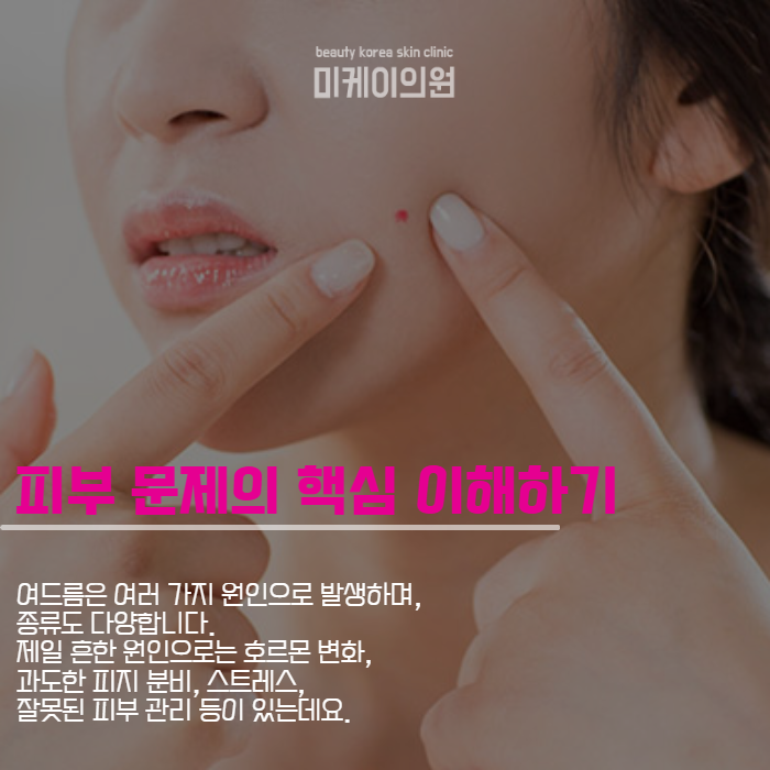 강남역 전문의 피부과 제공하는 맞춤형 여드름 치료 관련 이미지 2