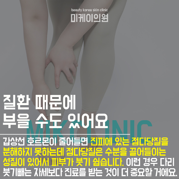 다리 붓기빼는 자세로 부종 정리할 수 있어요 관련 이미지 4