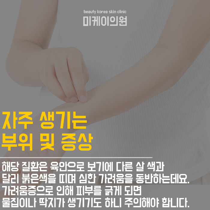 피부습진예방법 부드럽고 고운 손 만들기 관련 이미지 3