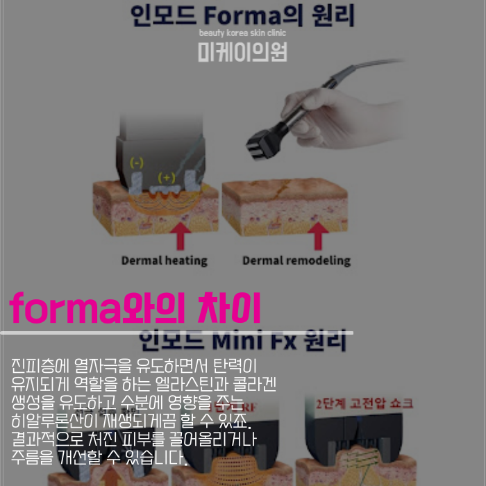 강남 인모드fx 얼굴 라인을 깔끔하게 관련 이미지 3
