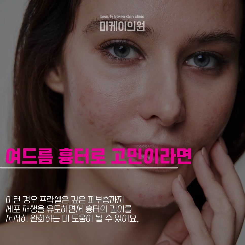 강남역피부과 흉터관리는 프락셀로 관련 이미지 3