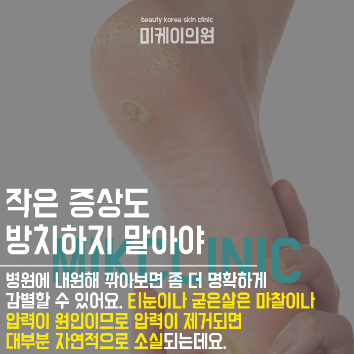 발바닥 티눈 원인 초기에 관리를 시작해요 관련 이미지 6