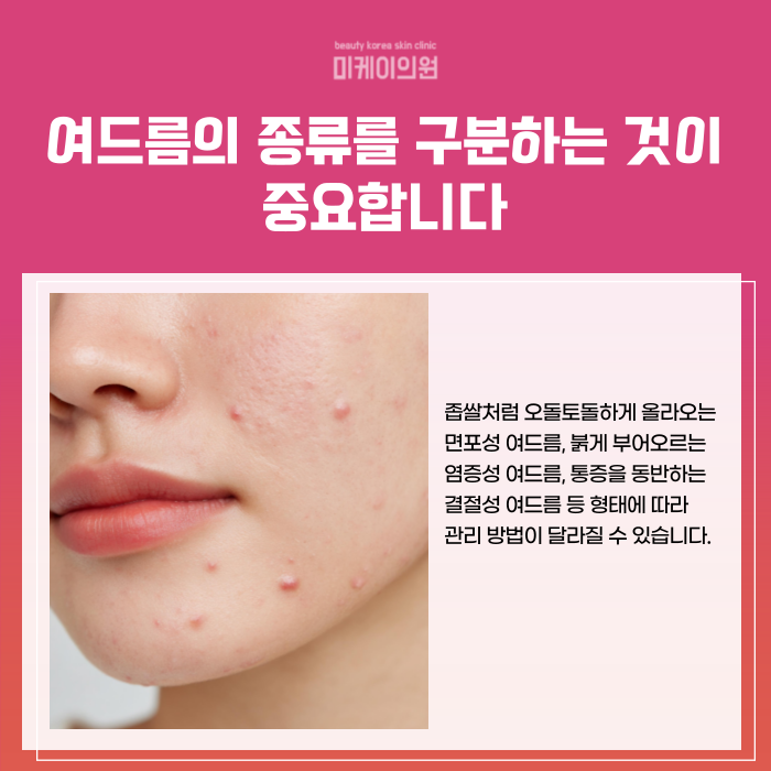 강남 여드름 피부과 잘하는곳 흉터 개선하고 싶다면 관련 이미지 2