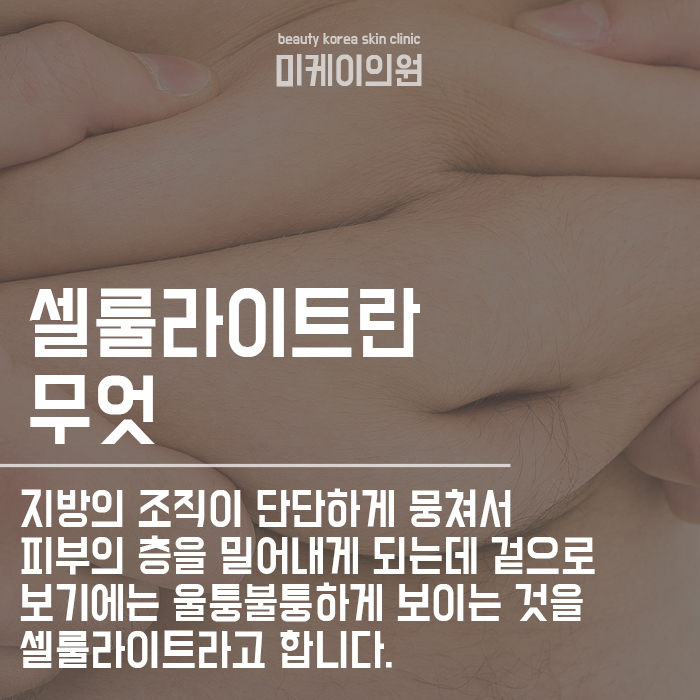강남역비만관리 옆구리 셀룰라이트 빠르게 분해 관련 이미지 2