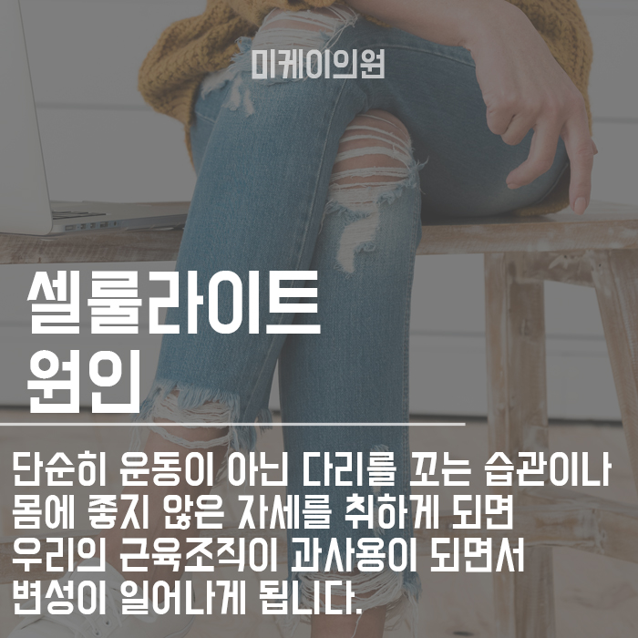 허벅지 셀룰라이트 제거시술 효과적인 것은 관련 이미지 4