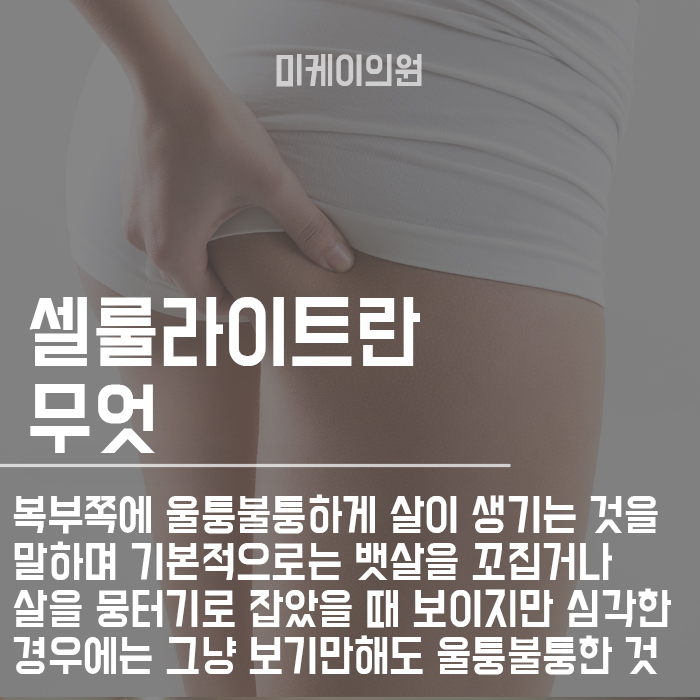 허벅지 셀룰라이트 제거시술 효과적인 것은 관련 이미지 2
