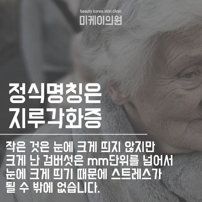 검버섯생기는 이유 예방법 관련 이미지 2