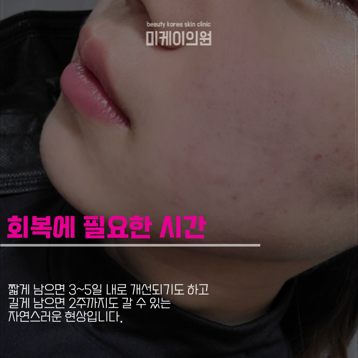인모드 멍 기간 짧게 끝내고 싶다면 관련 이미지 3