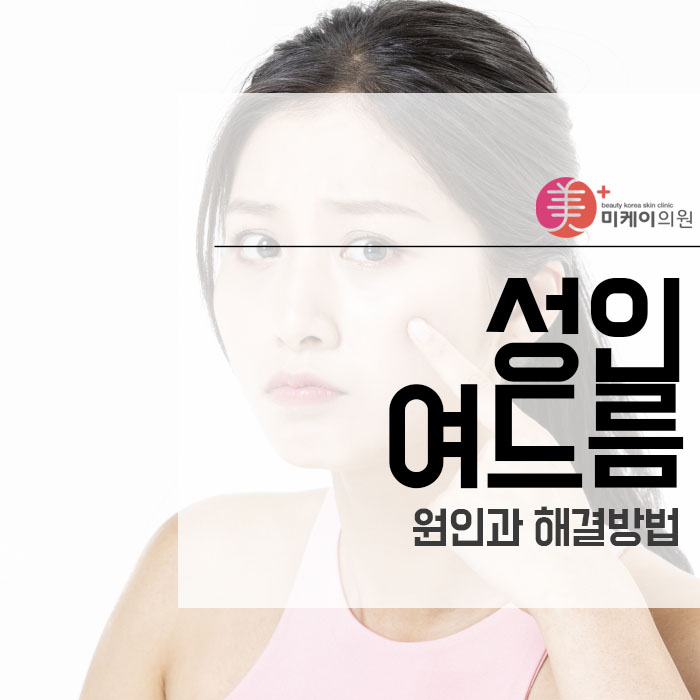 성인여드름 원인과 해결방법 관련 이미지 1
