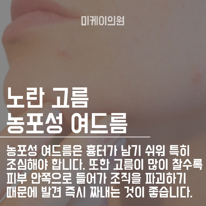 강남여드름피부과 깨끗한 피부를 갖고 싶다면 관련 이미지 4