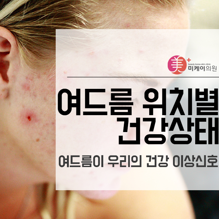 여드름 위치별 건강 상태 체크할 수 있어요! 관련 이미지 1