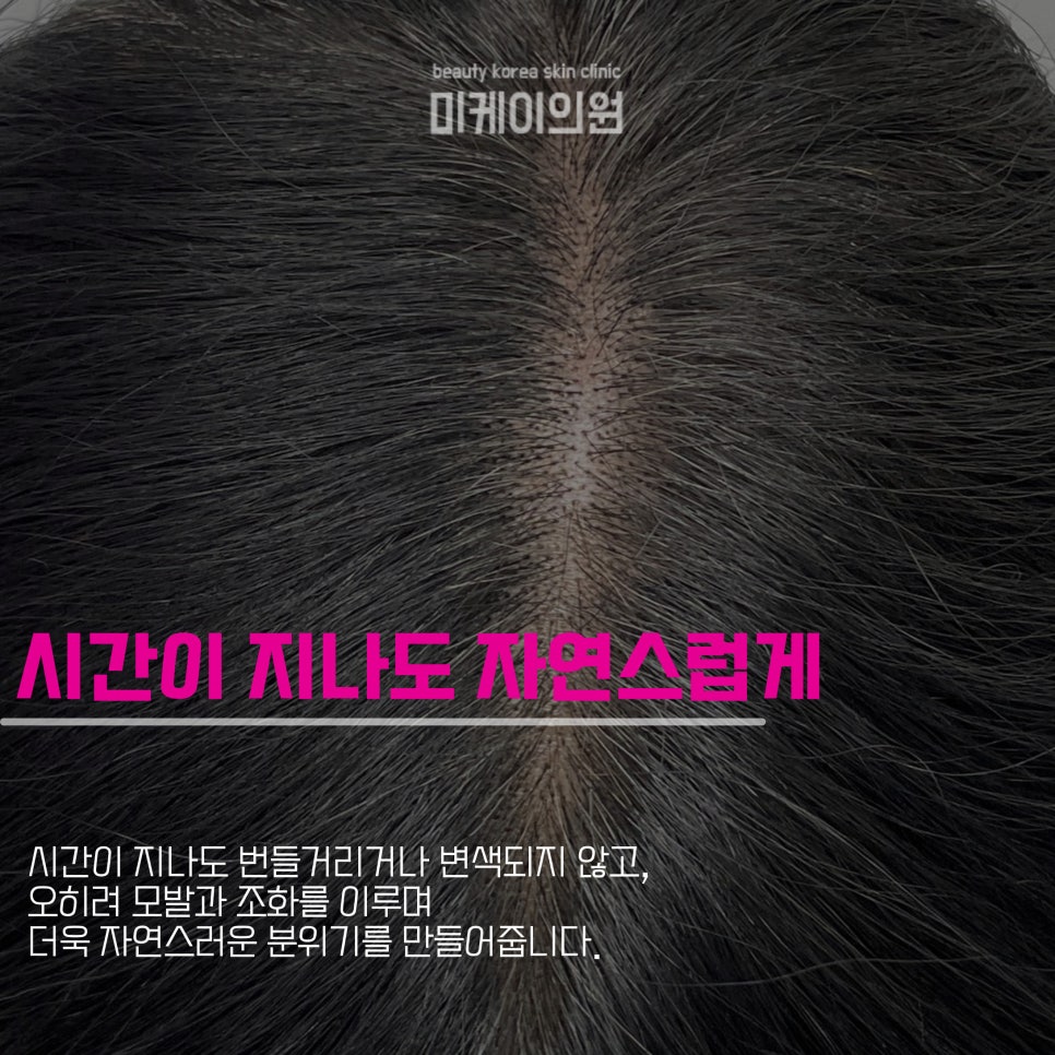 What Are the Benefits of Gangnam Part-Line Scalp Micropigmentation? image 4