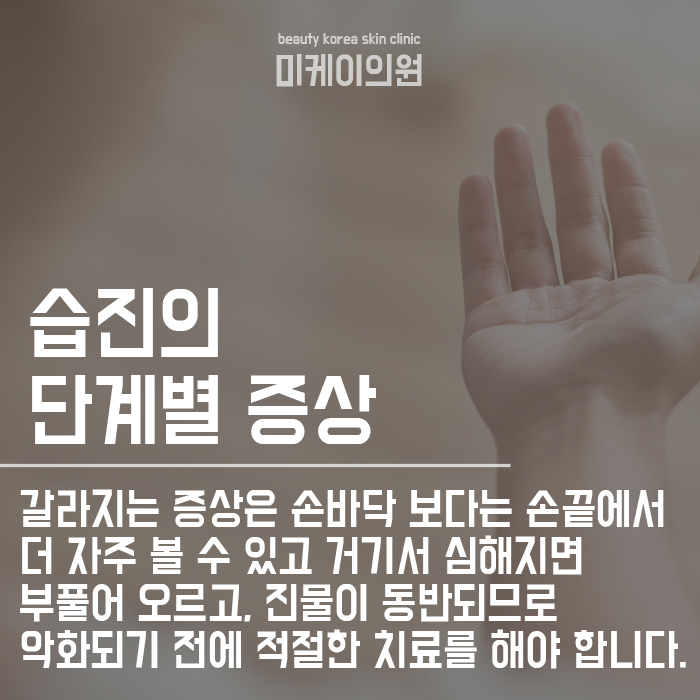 주부습진 관리법 및 예방 방법 무엇이 있을까? 관련 이미지 3