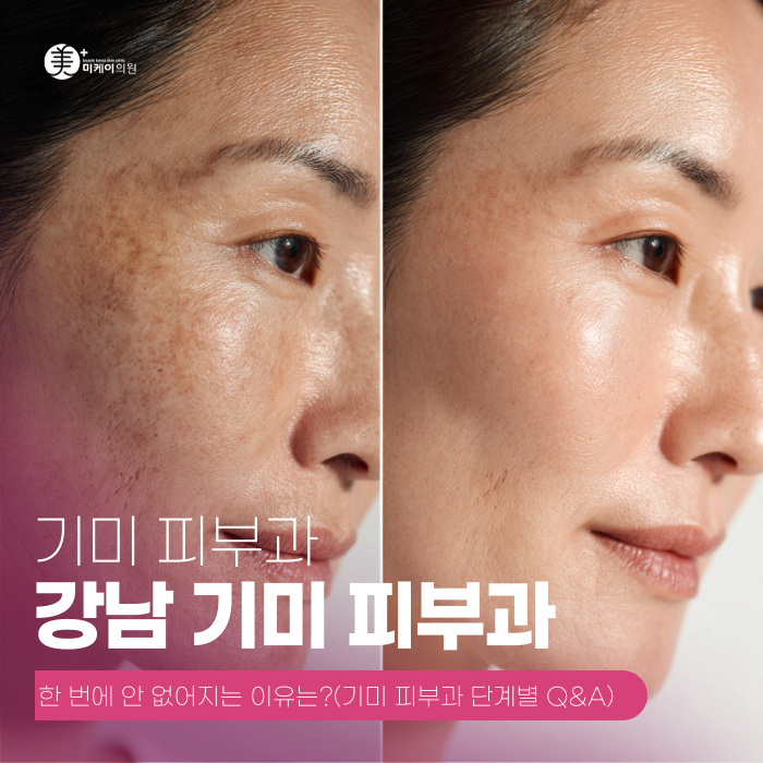 Gangnam Melasma Dermatology Clinic: Why Does It Keep Coming Back? image 1