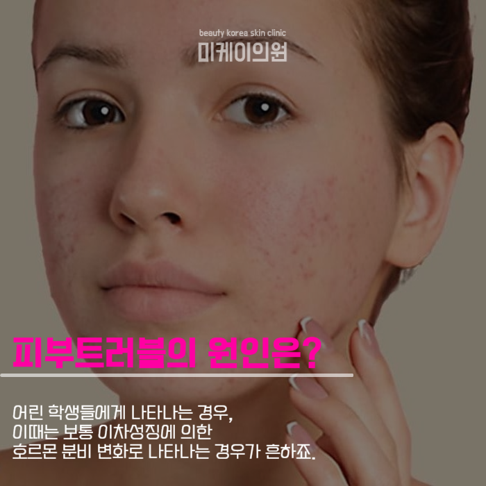 강남역여드름관리 병변부터 흉터까지 관련 이미지 2
