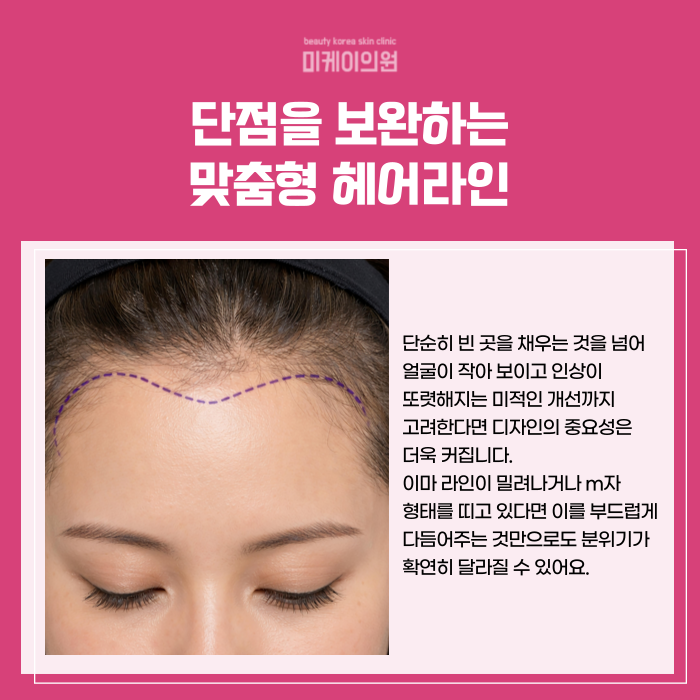 Gangnam Station, Seocho-gu SMP: Natural Hairline and Density image 4
