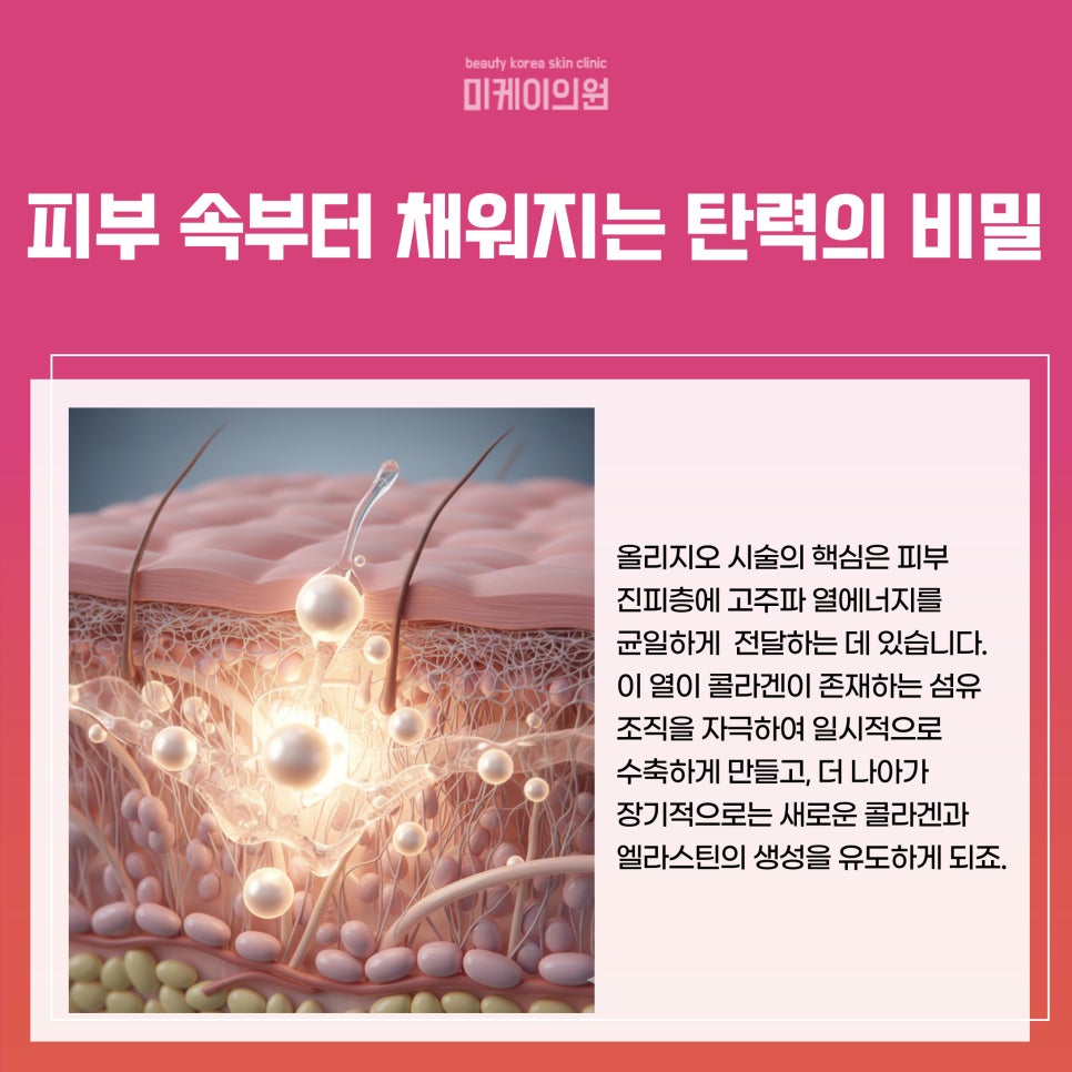 올리지오 시술 주기 집중 탐구 관련 이미지 2