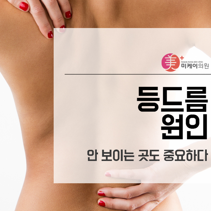 등드름 원인 안 보이는 곳도 중요하다 관련 이미지 1