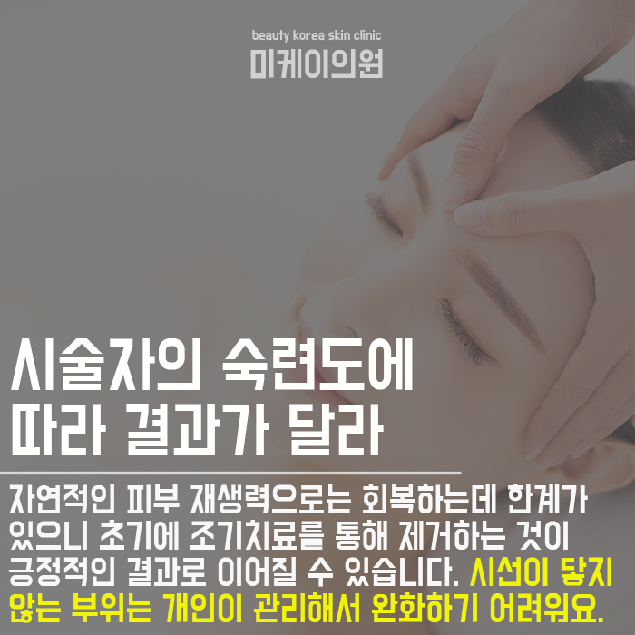 여드름검은색원인 개인에 따라 원인이 달라 관련 이미지 4