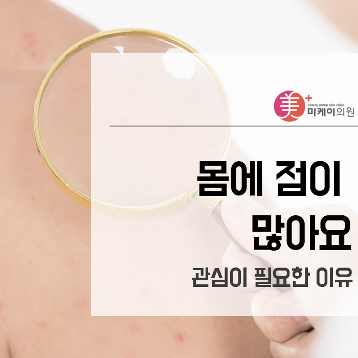 몸에점이많아요 관심이 필요한 이유 관련 이미지 1