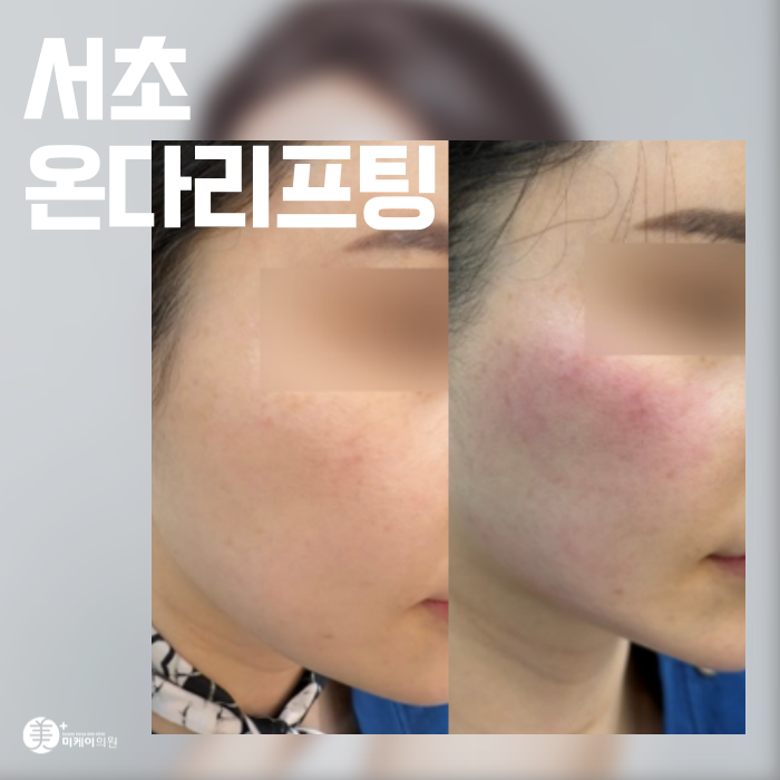 Seocho Onda Lifting: If Line Care Is Urgent image 1