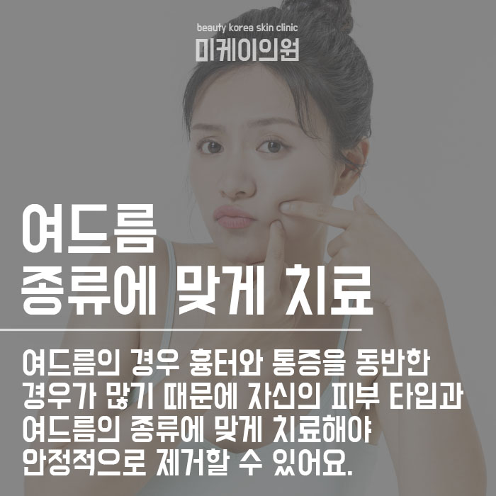 성인여드름 원인과 해결방법 관련 이미지 2