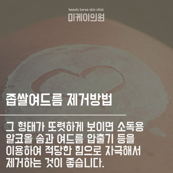 좁쌀여드름피부과 아직도 고민 중 이신가요 관련 이미지 3