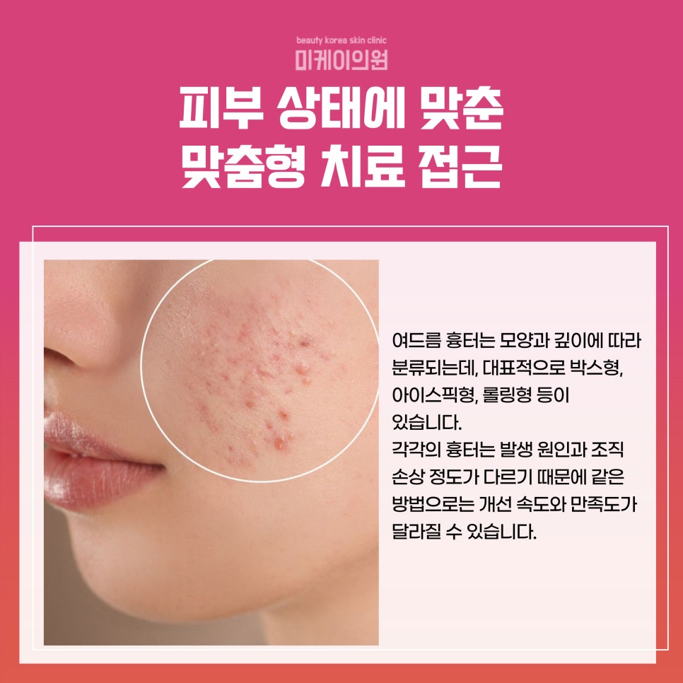 Regaining Confidence with Acne Scar Treatment in Seoul image 2