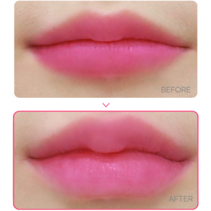 Where to Get Lip Fillers Near Gangnam Station: A Natural Design image 7