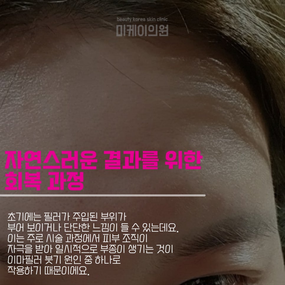 What Causes Swelling After Forehead Filler and How to Reduce It image 5