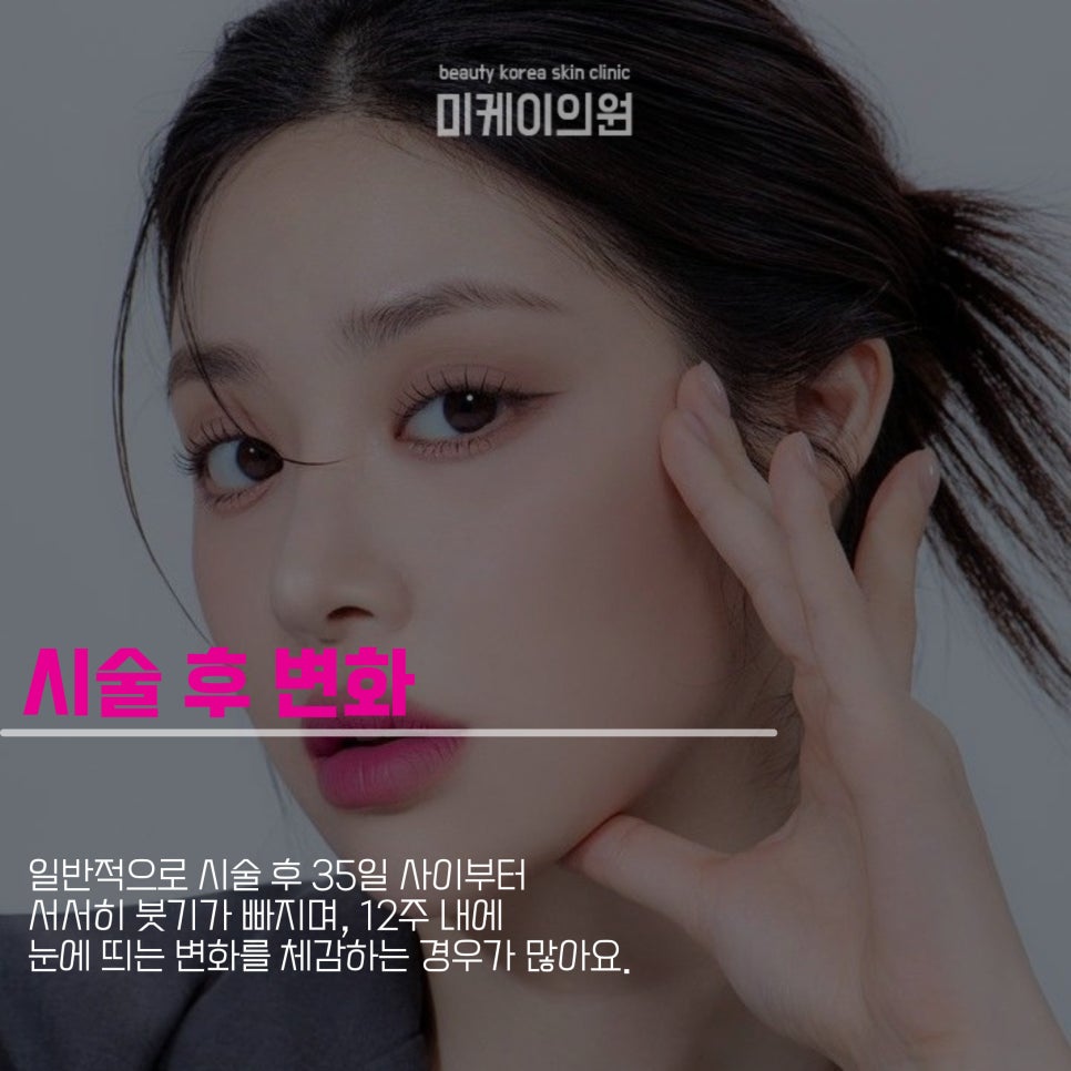 Removing Built-Up Fat with the Gangnam Gyalm Injection image 4