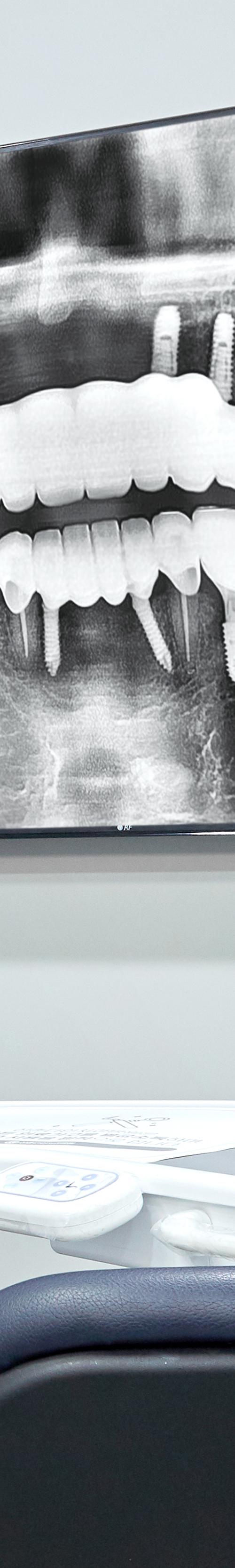 Yeongdeungpo Market Station Dental Clinic: Comfortable Under Conscious Sedation During Tooth Loss image 41
