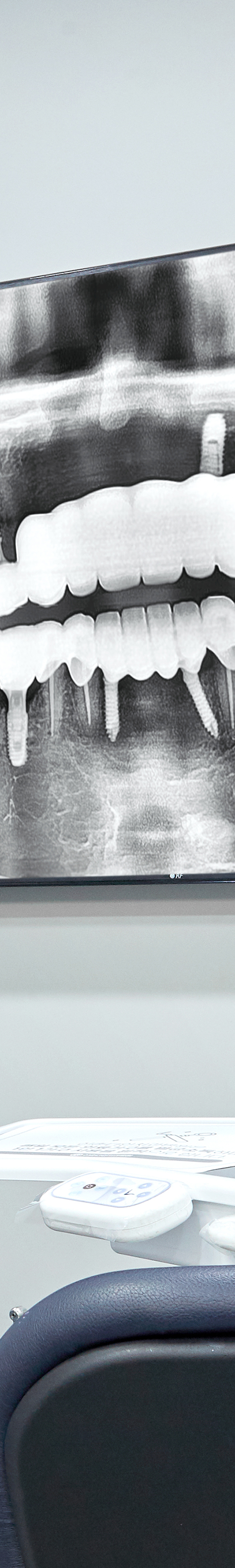 Mangwon-dong Dental Clinic Implant Procedure Based on Extensive Experience image 34