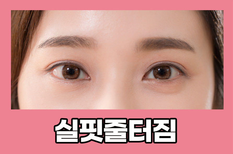 실핏줄터짐 눈 충혈 원인과 해결법 관련 이미지 1