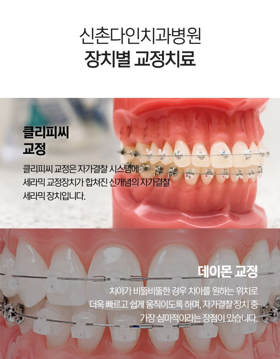 상도동치과 교정장치 시작하기 전에는 관련 이미지 6